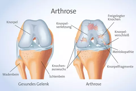 Abbildung Arthrose 