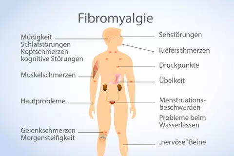 Abbildung Fibromyalgie 