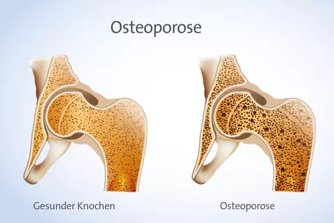 Abbildung Osteoporose 