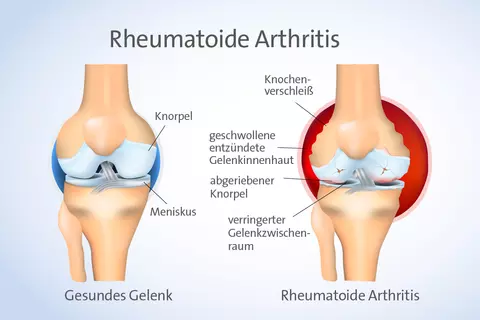 Abbildung Rheumatische Arthritis 